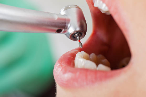 Best Emergency Dentist for Lost Fillings or Crowns in Fairmount, NY